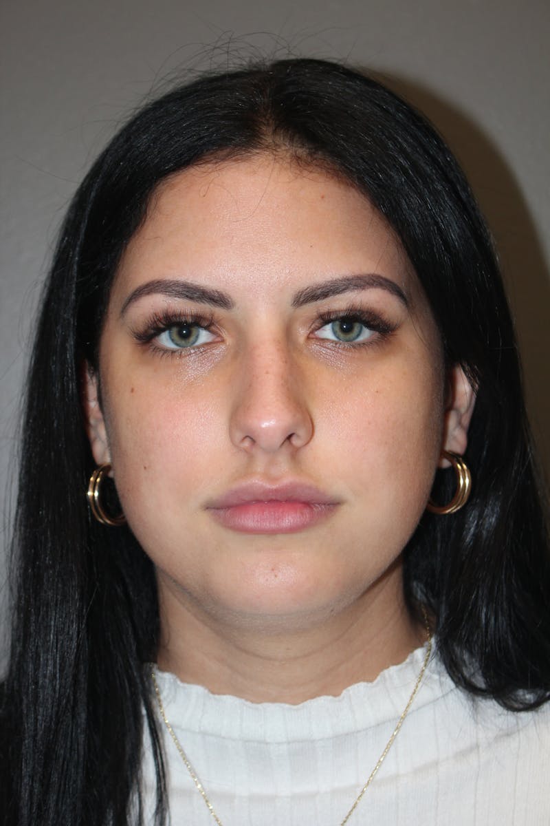 Rhinoplasty Before & After Gallery - Patient 173758 - Image 5