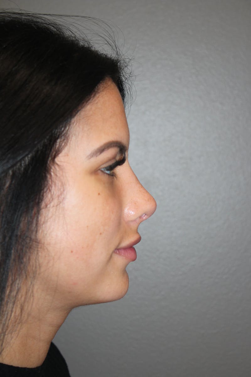 Rhinoplasty Before & After Gallery - Patient 173758 - Image 2