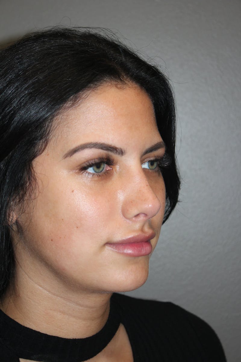 Rhinoplasty Before & After Gallery - Patient 173758 - Image 4