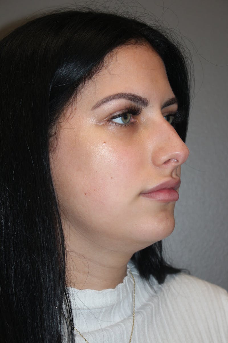 Rhinoplasty Before & After Gallery - Patient 173758 - Image 3