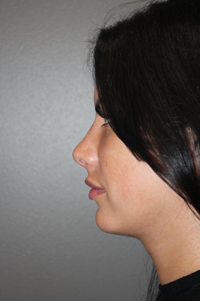 Rhinoplasty Before & After Gallery - Patient 173758 - Image 10