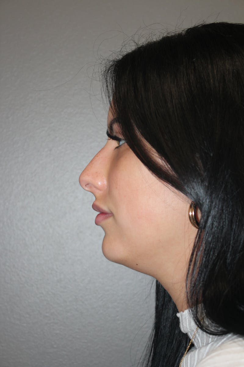 Rhinoplasty Before & After Gallery - Patient 173758 - Image 9