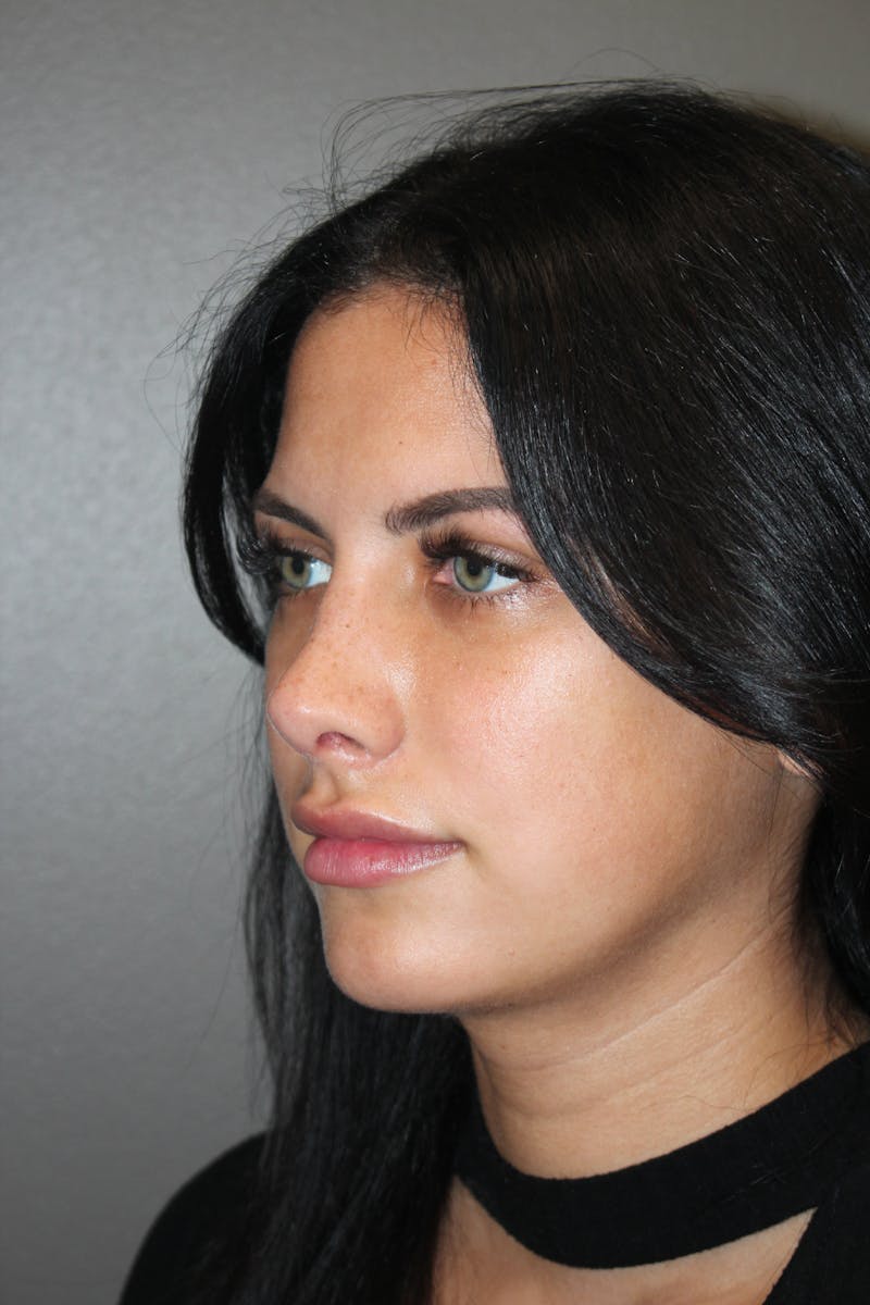 Rhinoplasty Before & After Gallery - Patient 173758 - Image 8