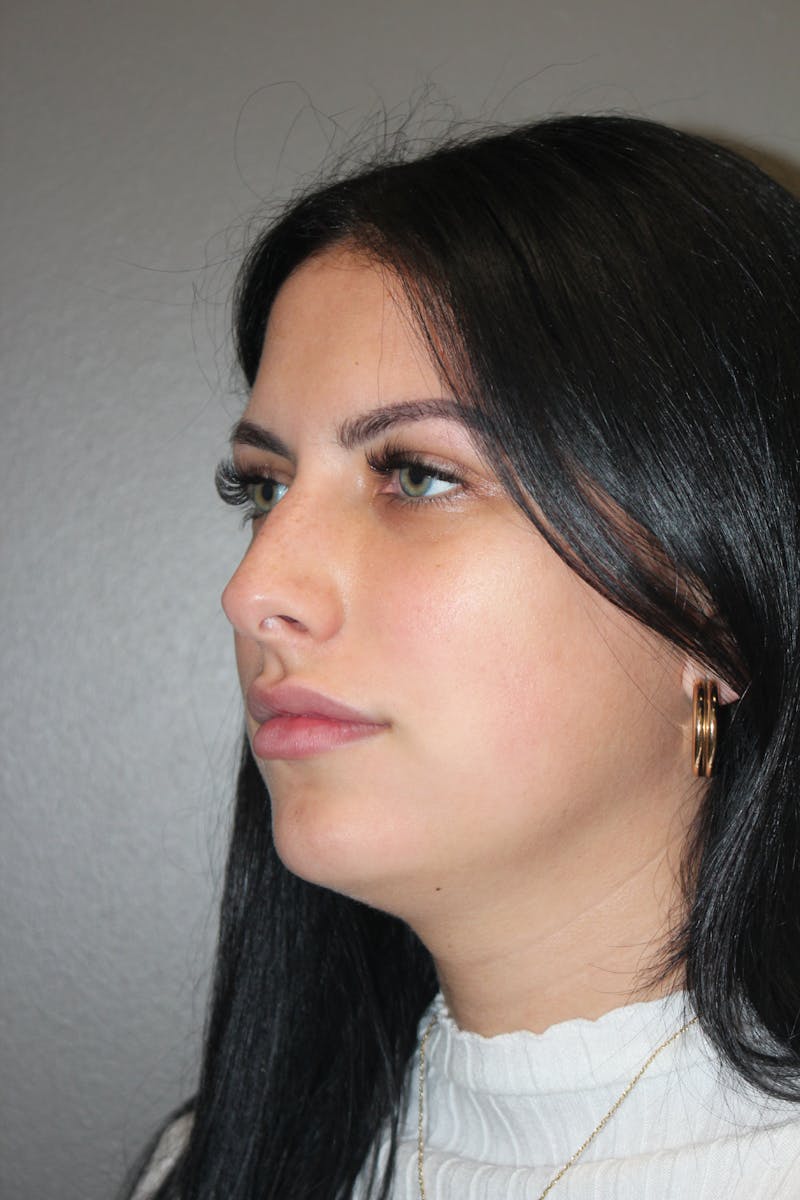 Rhinoplasty Before & After Gallery - Patient 173758 - Image 7