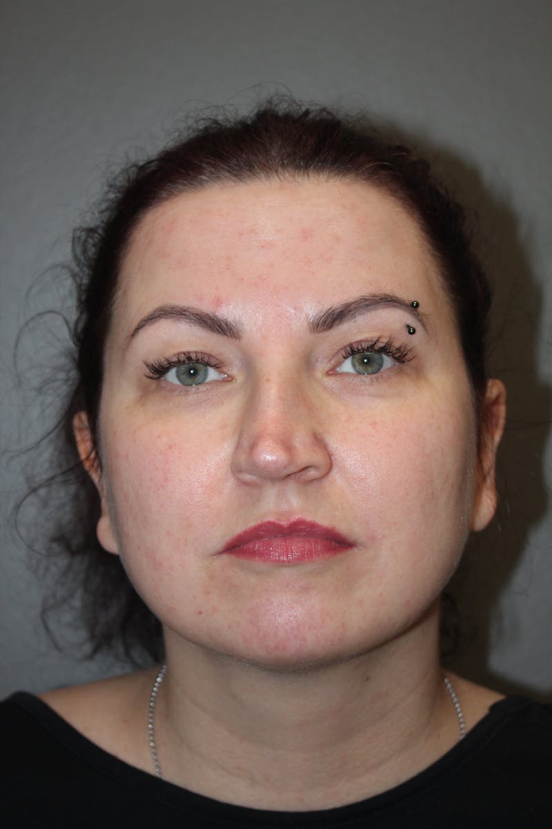 Rhinoplasty Before & After Gallery - Patient 193208 - Image 5