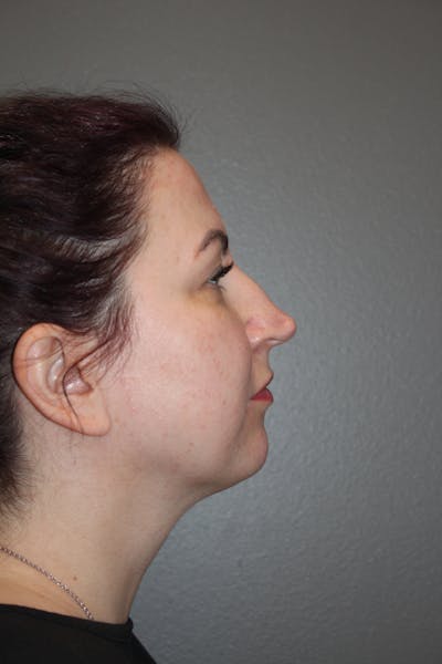 Rhinoplasty Before & After Gallery - Patient 193208 - Image 1