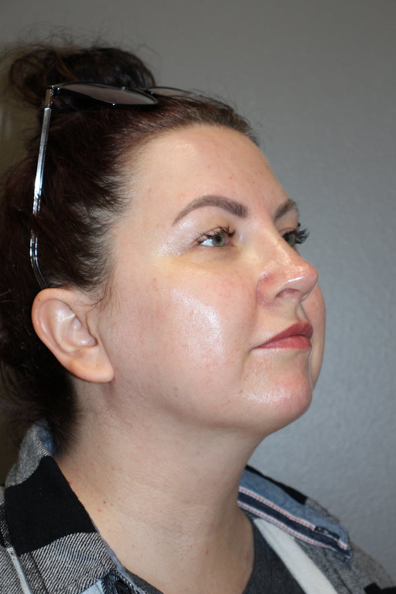Rhinoplasty Before & After Gallery - Patient 193208 - Image 4