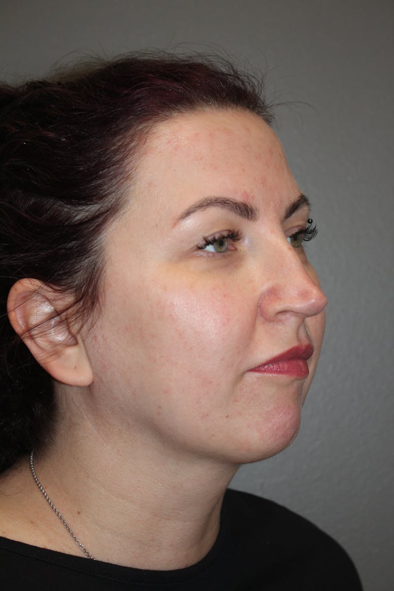 Rhinoplasty Before & After Gallery - Patient 193208 - Image 3