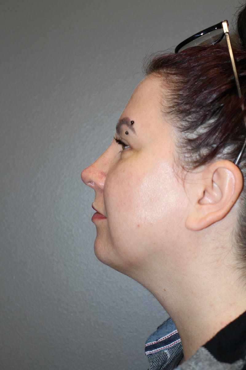 Rhinoplasty Before & After Gallery - Patient 193208 - Image 10
