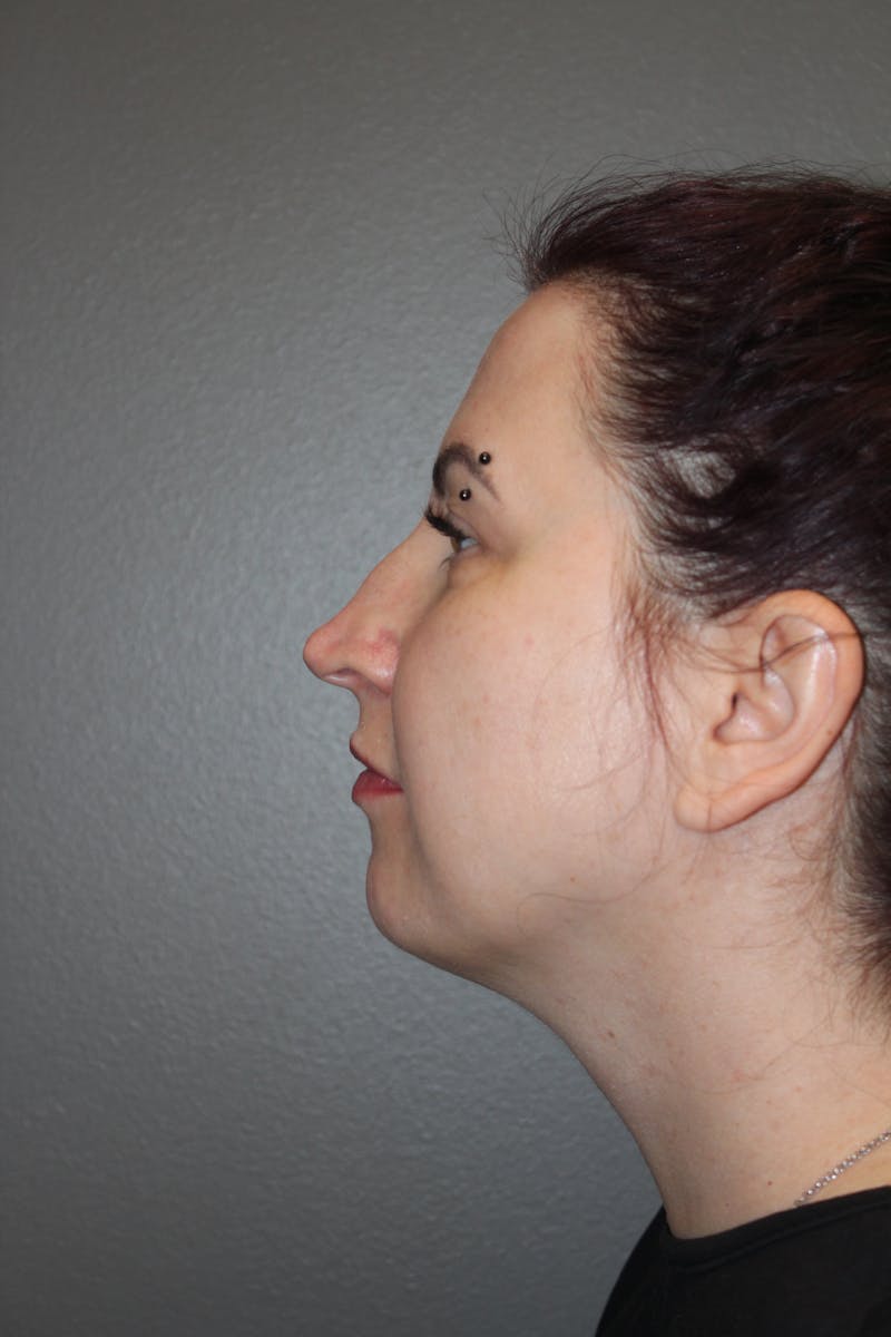 Rhinoplasty Before & After Gallery - Patient 193208 - Image 9