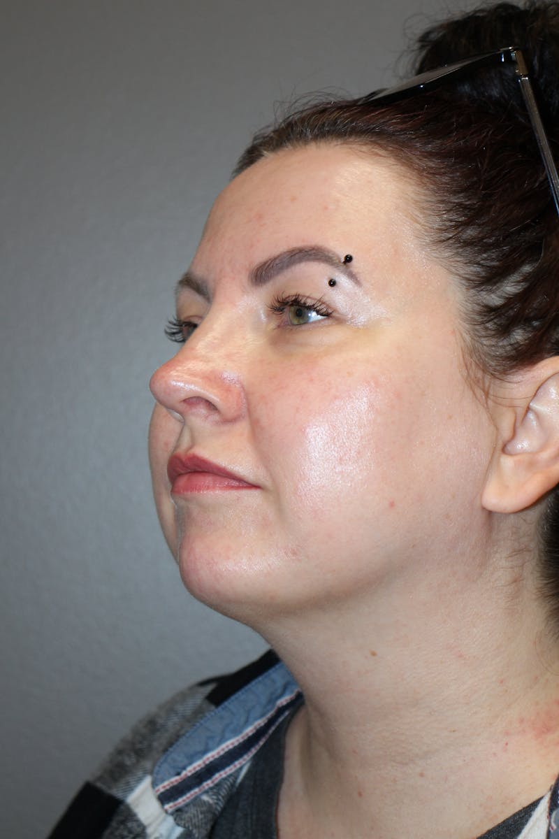 Rhinoplasty Before & After Gallery - Patient 193208 - Image 8