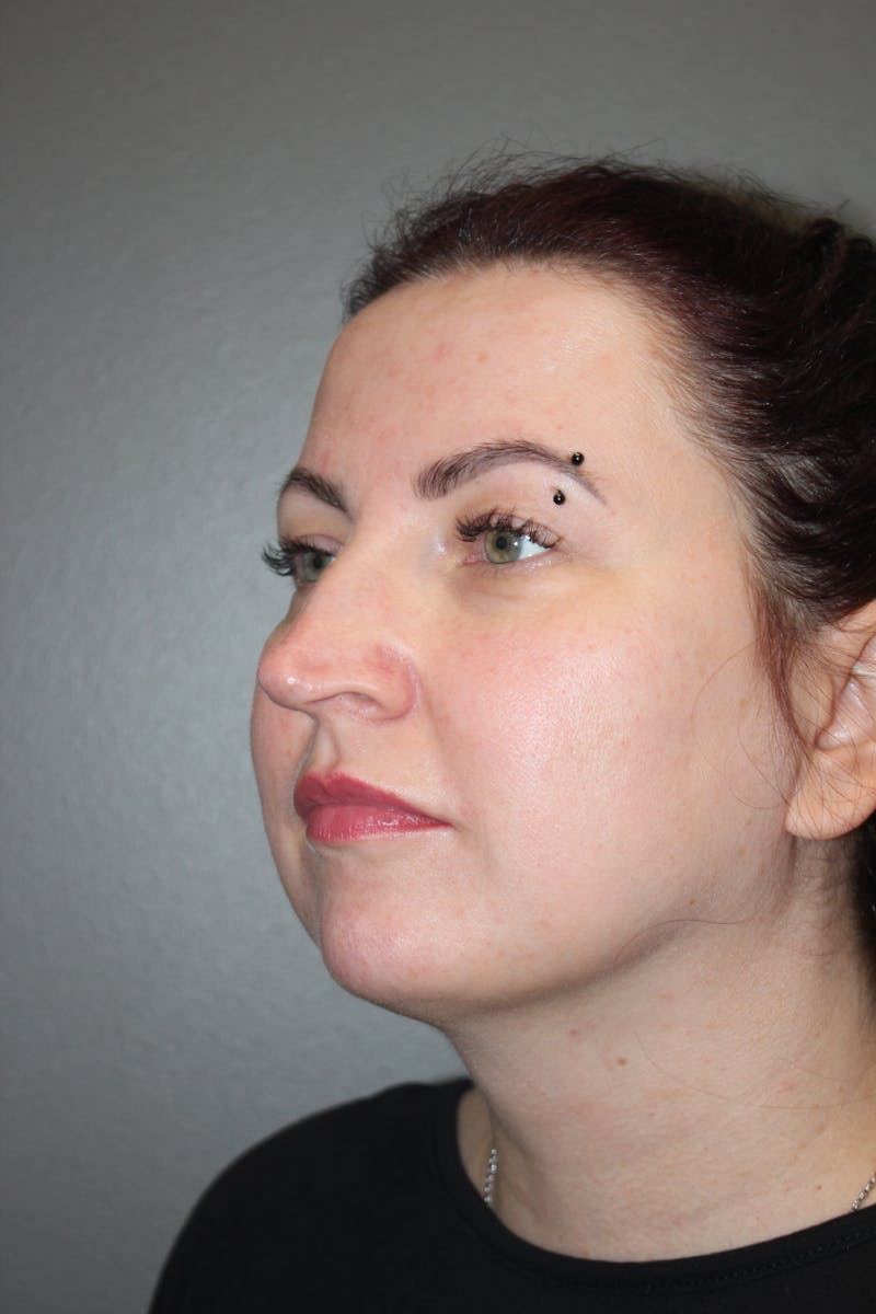 Rhinoplasty Before & After Gallery - Patient 193208 - Image 7