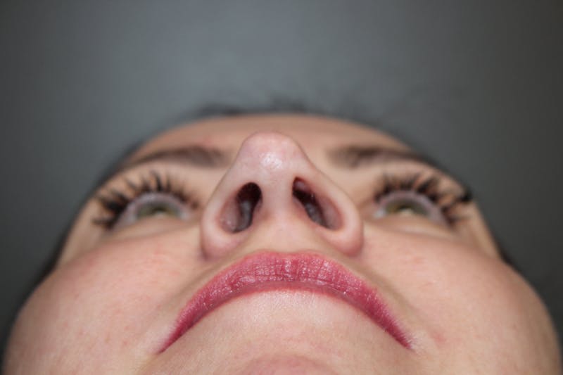 Rhinoplasty Before & After Gallery - Patient 193208 - Image 11