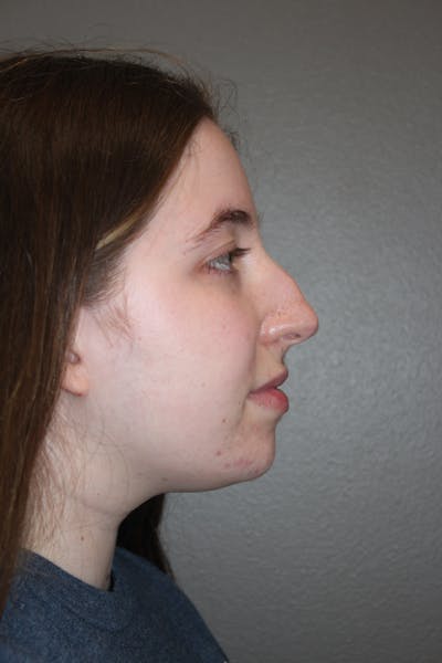Rhinoplasty Before & After Gallery - Patient 373017 - Image 1