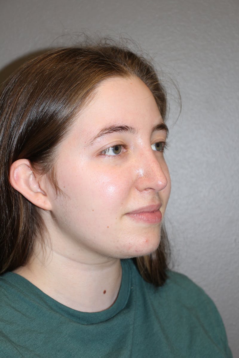 Rhinoplasty Before & After Gallery - Patient 373017 - Image 4