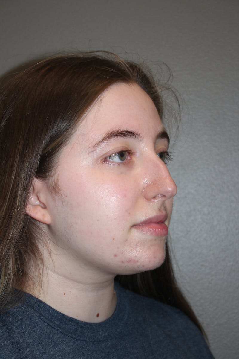 Rhinoplasty Before & After Gallery - Patient 373017 - Image 3
