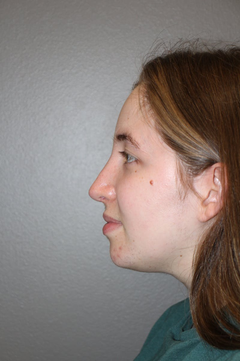 Rhinoplasty Before & After Gallery - Patient 373017 - Image 10