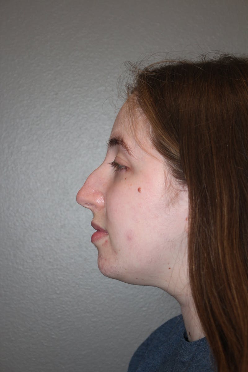 Rhinoplasty Before & After Gallery - Patient 373017 - Image 9
