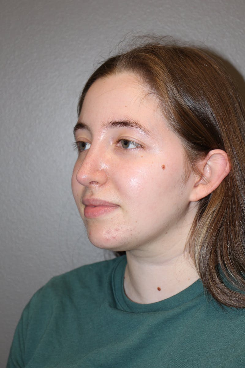 Rhinoplasty Before & After Gallery - Patient 373017 - Image 8