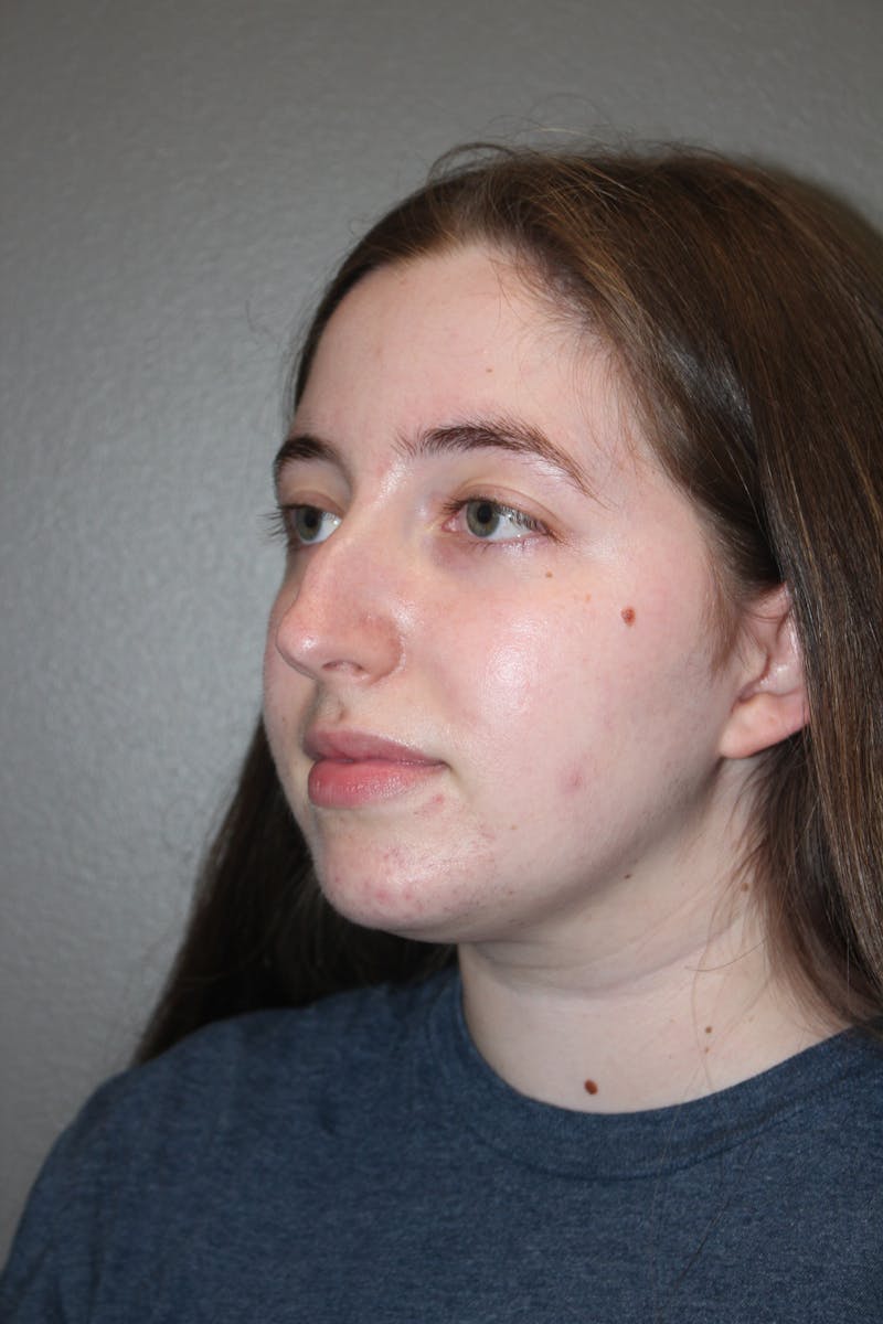 Rhinoplasty Before & After Gallery - Patient 373017 - Image 7