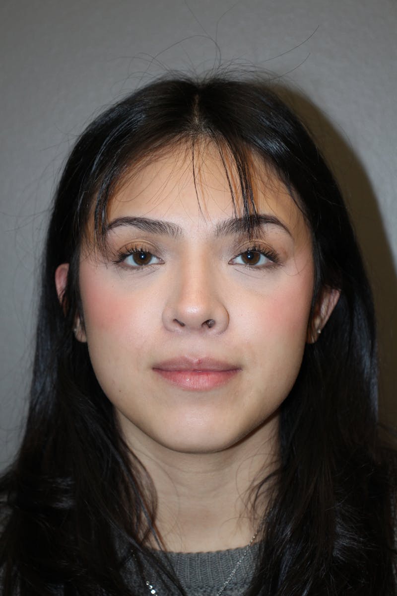 Rhinoplasty Before & After Gallery - Patient 800423 - Image 6