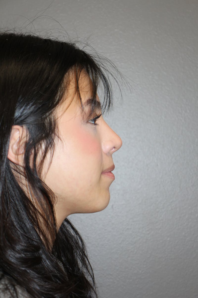 Rhinoplasty Before & After Gallery - Patient 800423 - Image 2