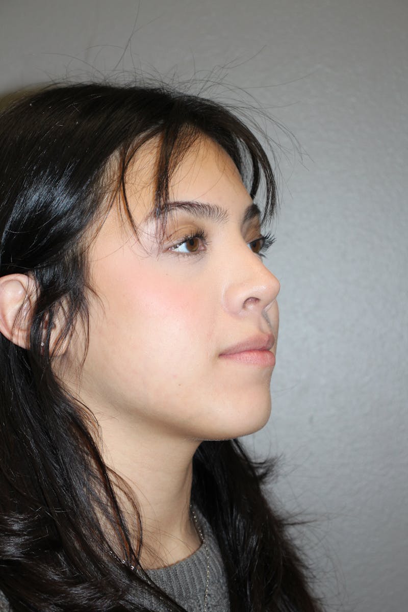 Rhinoplasty Before & After Gallery - Patient 800423 - Image 4