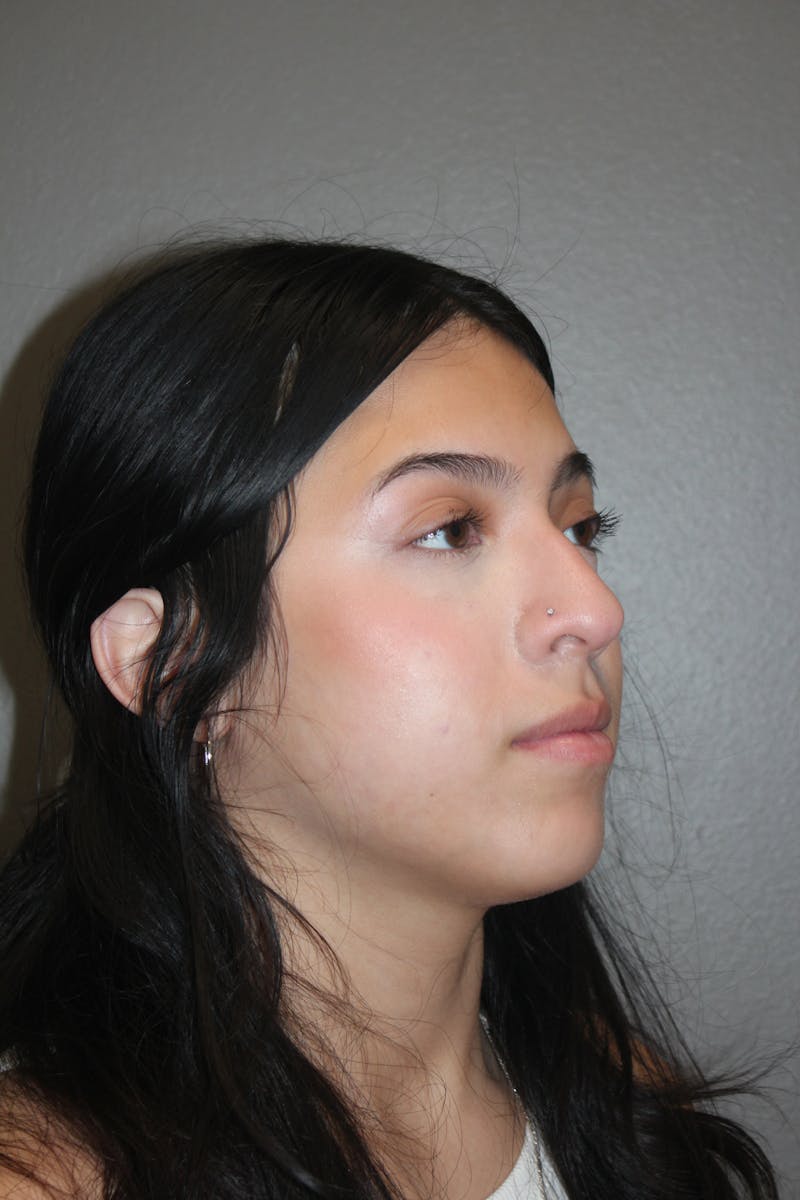 Rhinoplasty Before & After Gallery - Patient 800423 - Image 3