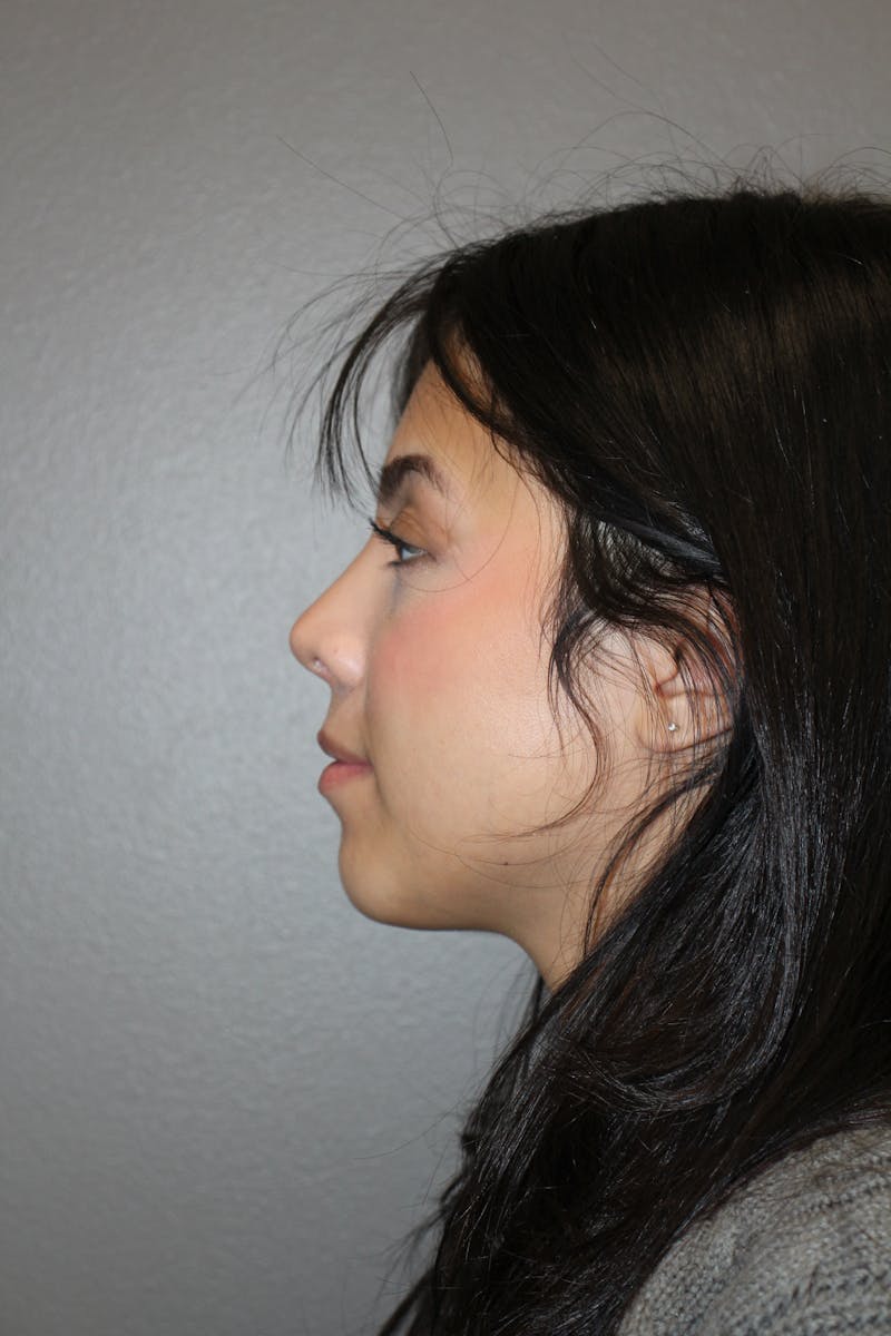 Rhinoplasty Before & After Gallery - Patient 800423 - Image 10