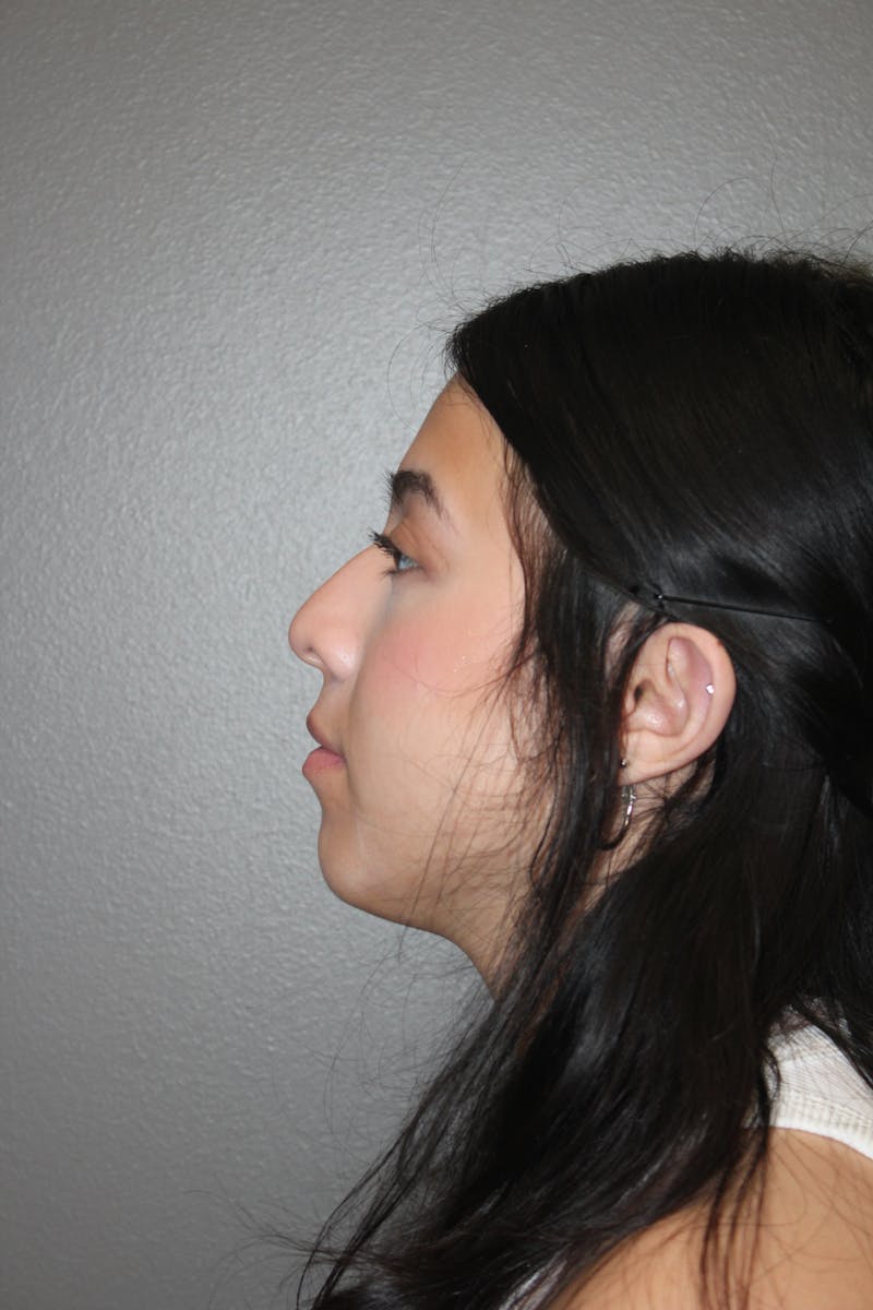Rhinoplasty Before & After Gallery - Patient 800423 - Image 9
