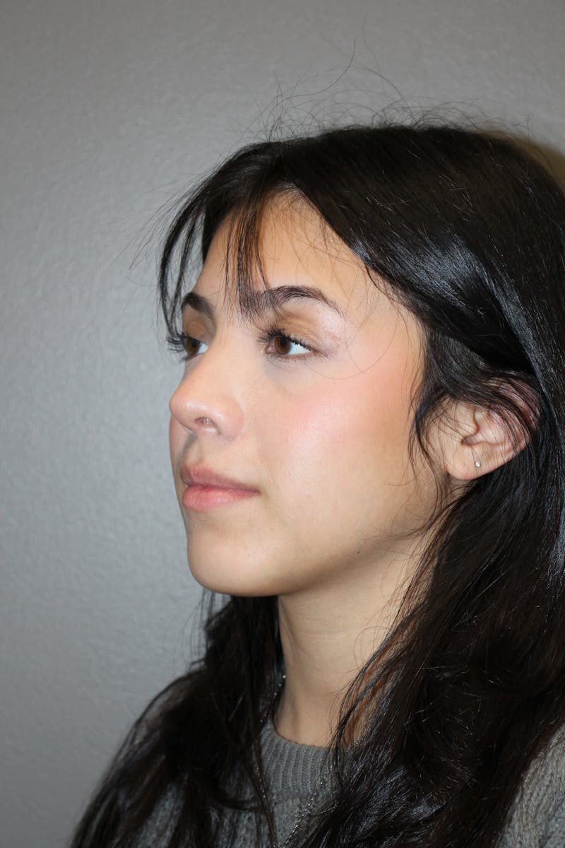 Rhinoplasty Before & After Gallery - Patient 800423 - Image 8