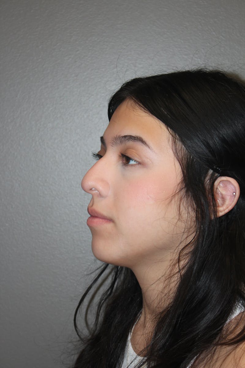 Rhinoplasty Before & After Gallery - Patient 800423 - Image 7