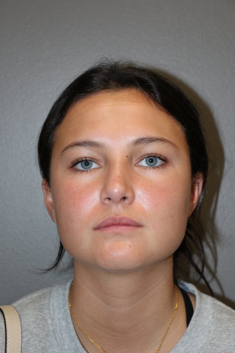 Rhinoplasty Before & After Gallery - Patient 130832 - Image 6