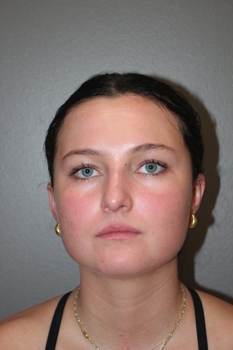 Rhinoplasty Before & After Gallery - Patient 130832 - Image 5