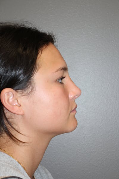 Rhinoplasty Before & After Gallery - Patient 130832 - Image 2