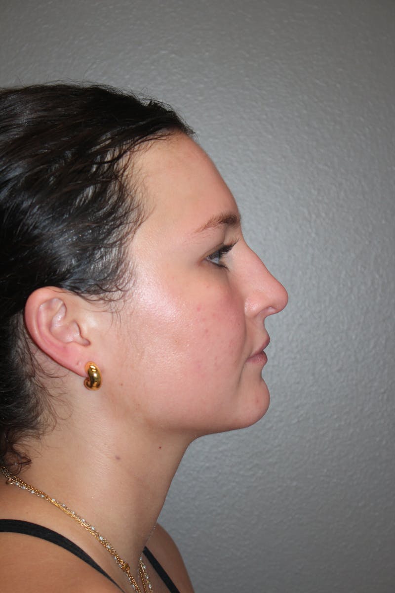 Rhinoplasty Before & After Gallery - Patient 130832 - Image 1