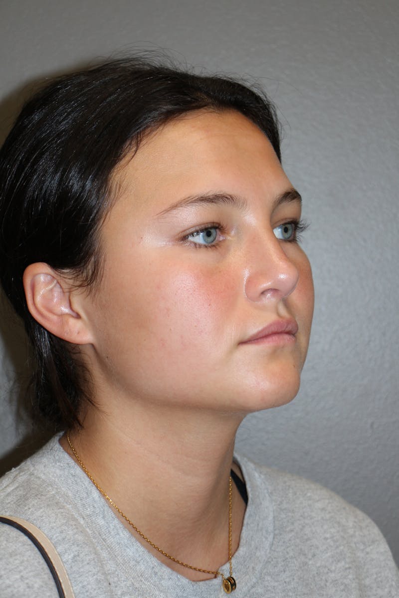 Rhinoplasty Before & After Gallery - Patient 130832 - Image 4