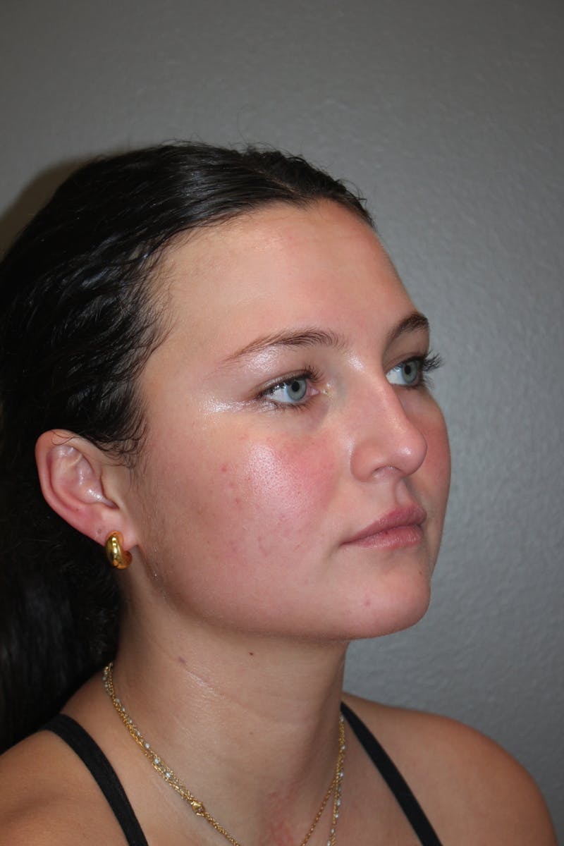 Rhinoplasty Before & After Gallery - Patient 130832 - Image 3