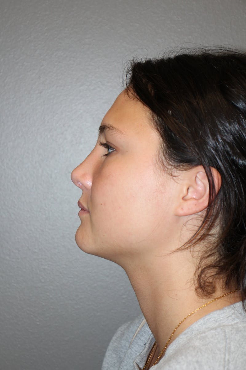 Rhinoplasty Before & After Gallery - Patient 130832 - Image 10