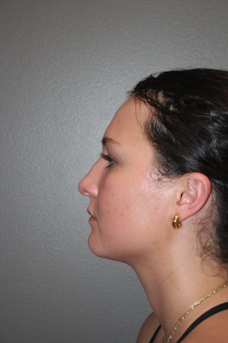 Rhinoplasty Before & After Gallery - Patient 130832 - Image 9