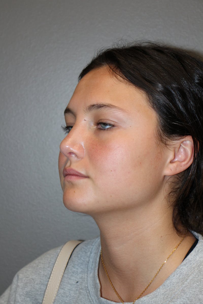 Rhinoplasty Before & After Gallery - Patient 130832 - Image 8
