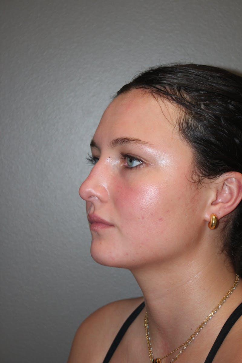 Rhinoplasty Before & After Gallery - Patient 130832 - Image 7
