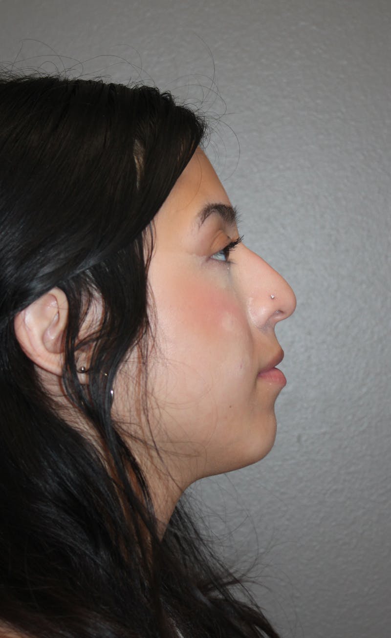 Rhinoplasty Before & After Gallery - Patient 800423 - Image 1