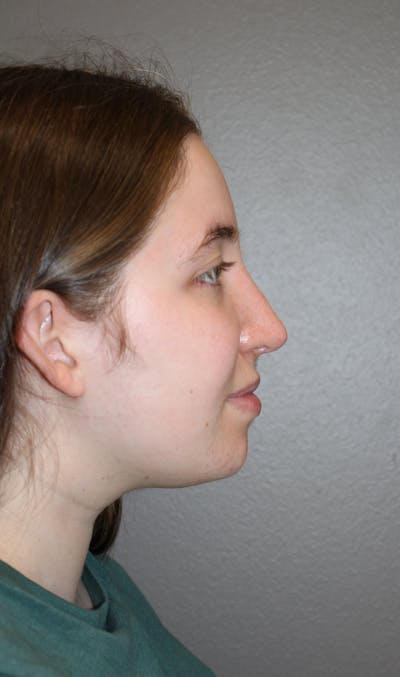 Rhinoplasty Before & After Gallery - Patient 373017 - Image 2