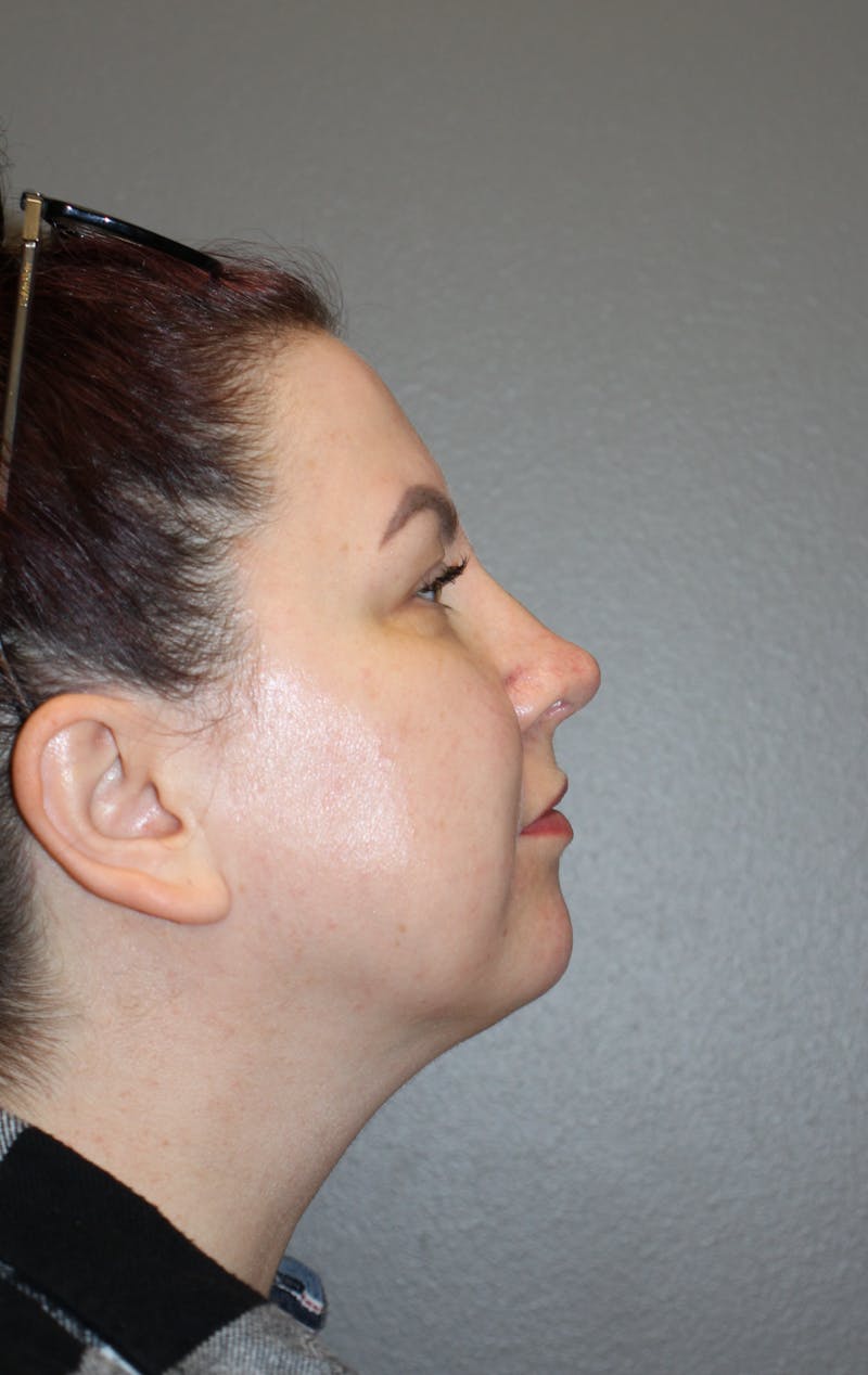 Rhinoplasty Before & After Gallery - Patient 193208 - Image 2
