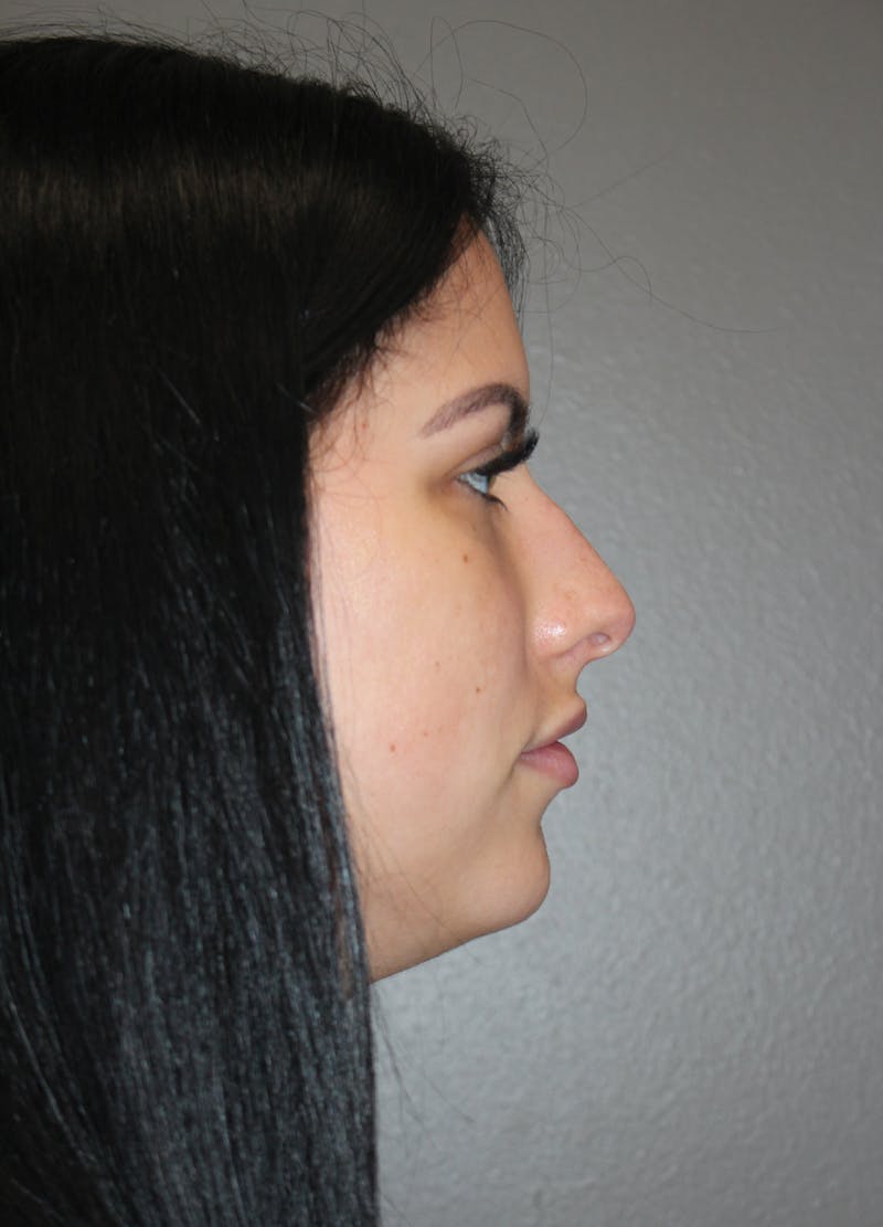 Rhinoplasty Before & After Gallery - Patient 173758 - Image 1