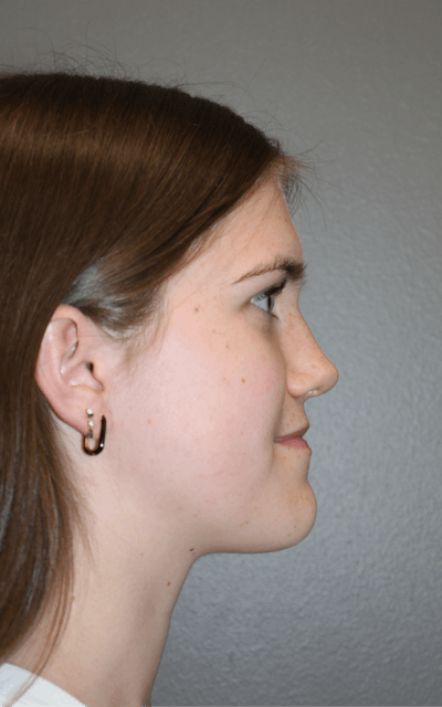 Rhinoplasty Before & After Gallery - Patient 192728 - Image 2