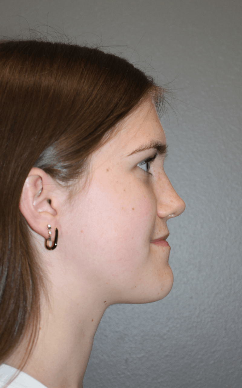 Rhinoplasty Before & After Gallery - Patient 192728 - Image 2