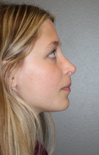 Rhinoplasty Before & After Gallery - Patient 415553 - Image 2