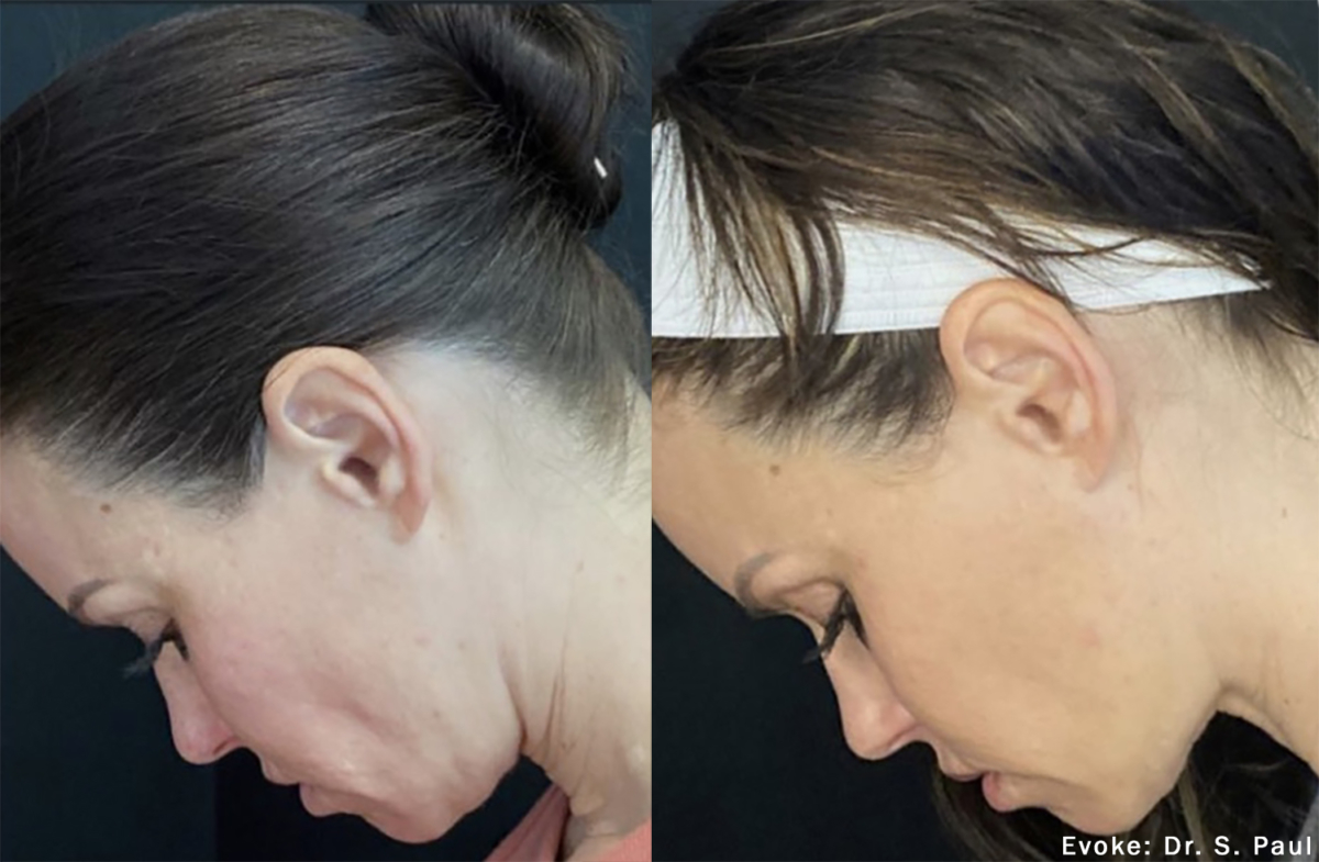 Before and after EVOKE treatment in Austin at Modern Women's Health